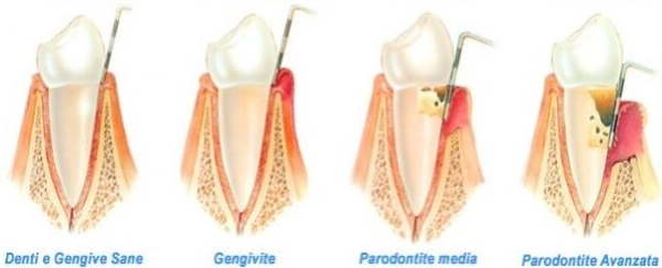 Denti paradontite gengivite